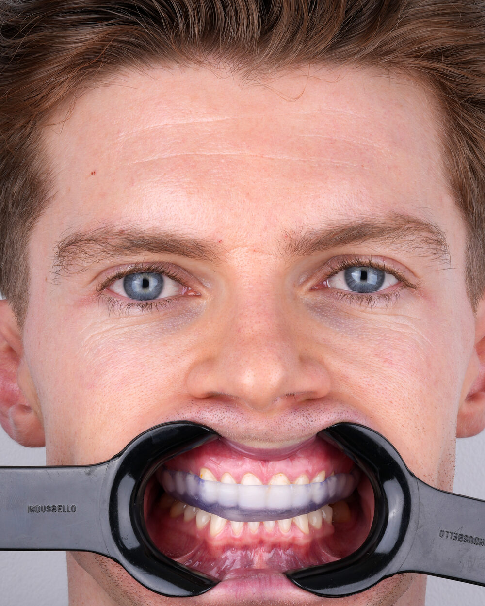 BITEX nightguard fitted intraorally, clinical photograph