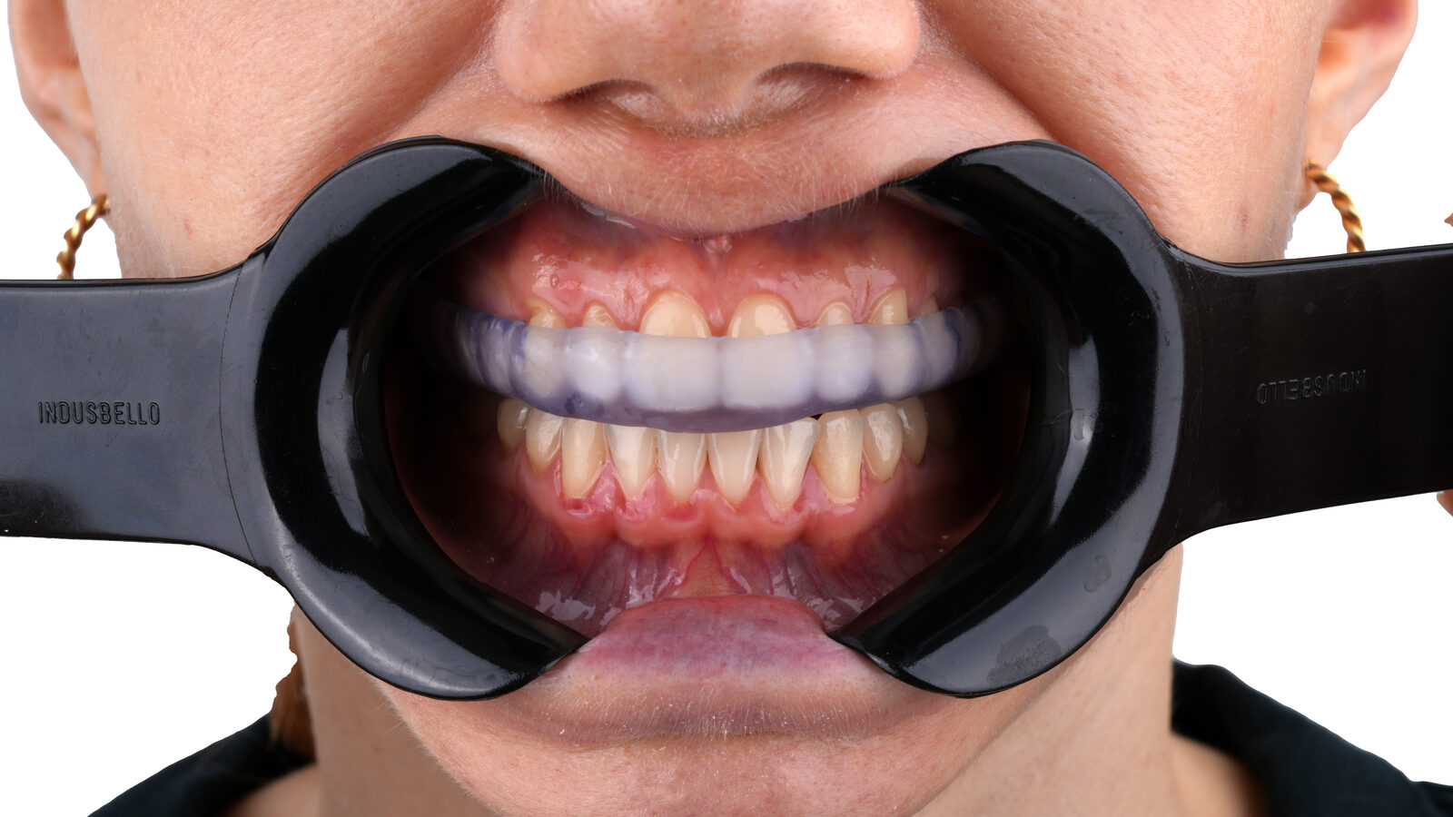 Close-up clinical photograph of the BITEX nightguard fitted intraorally